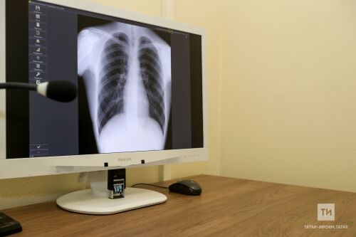 Табиб күрсәтмәсе булмаган килеш компьютер томографиясе ясатмаска киңәш иттеләр