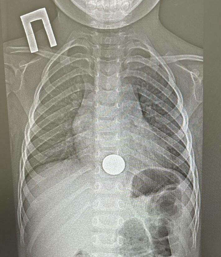 Түбән Камада табиблар тимер тәңгә йоткан баланы коткарган